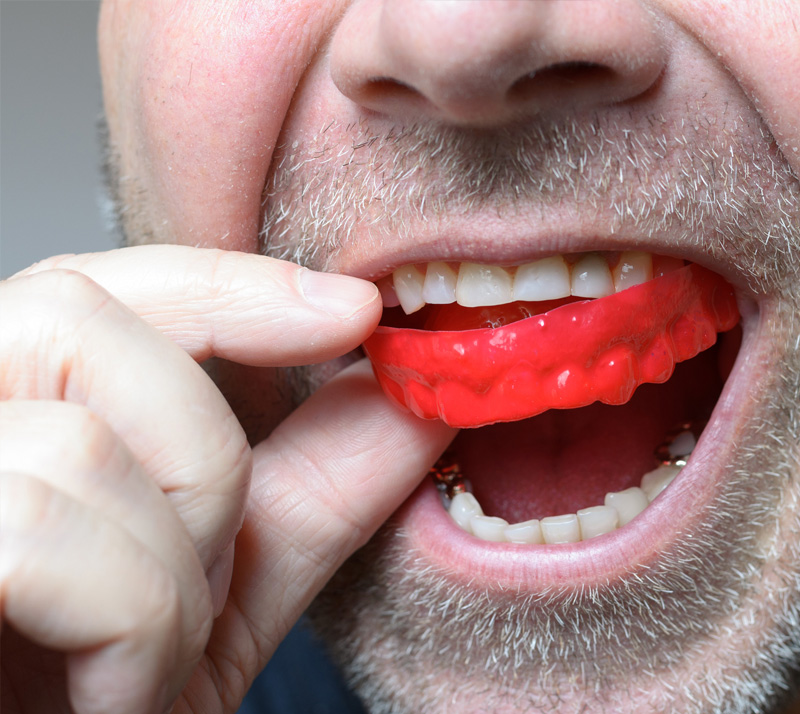 Dental-Appliances-1 Dr. Peter Servinis