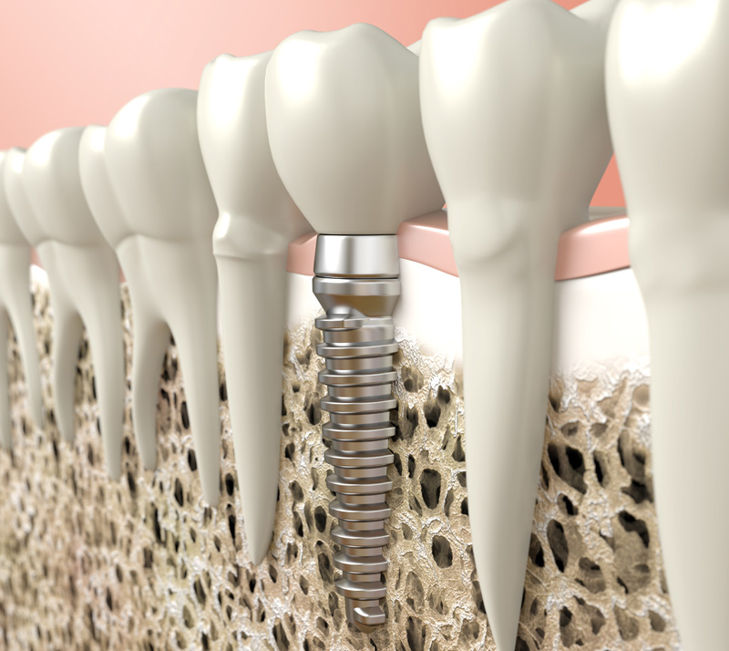 all on 4 dental implants in burnaby all on 4 dental implants in burnaby