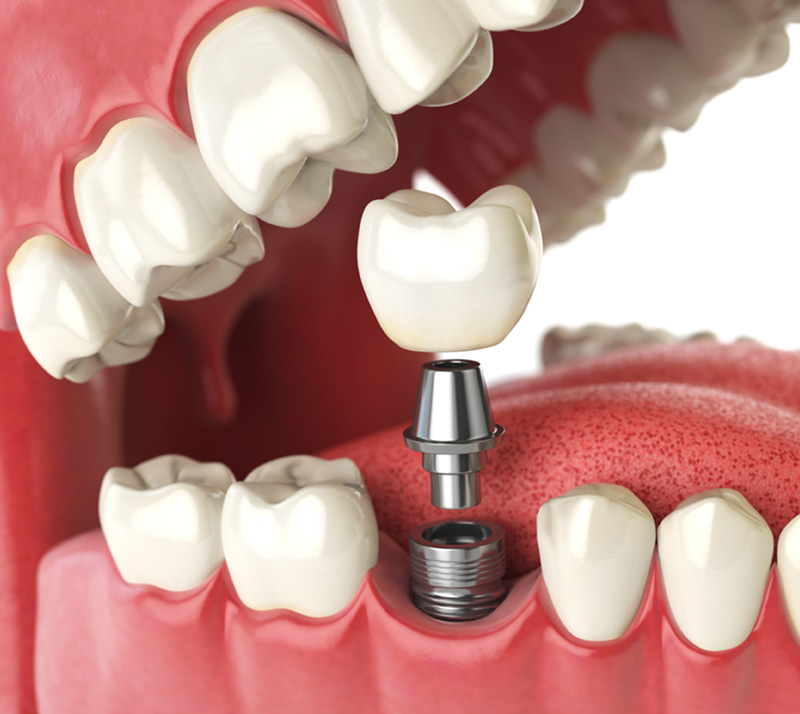 all on 4 dental implants near you