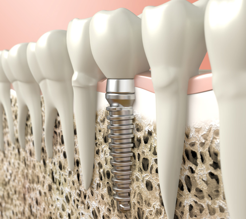 dental implants in burnaby