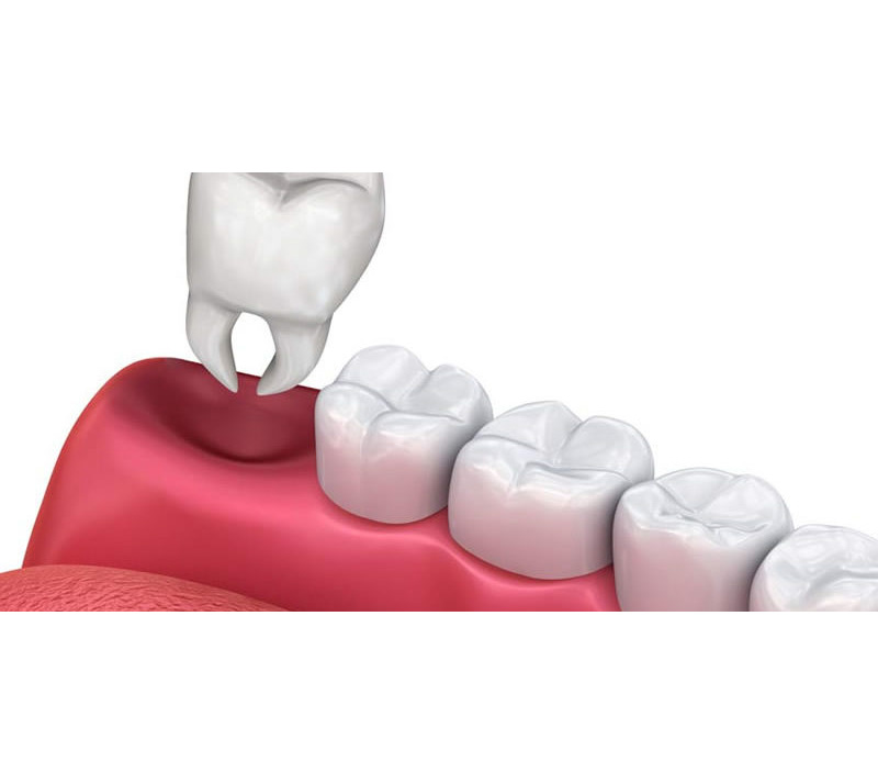 teeth extractions in burnaby