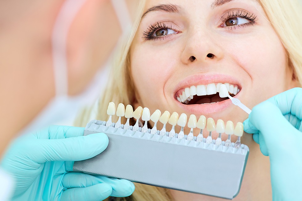 Veneers: A Good Investment – Eagle Creek Dental