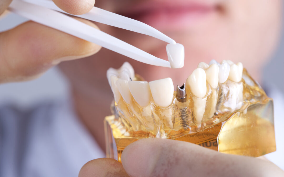 Why Dental Implants Are Better Than Dentures