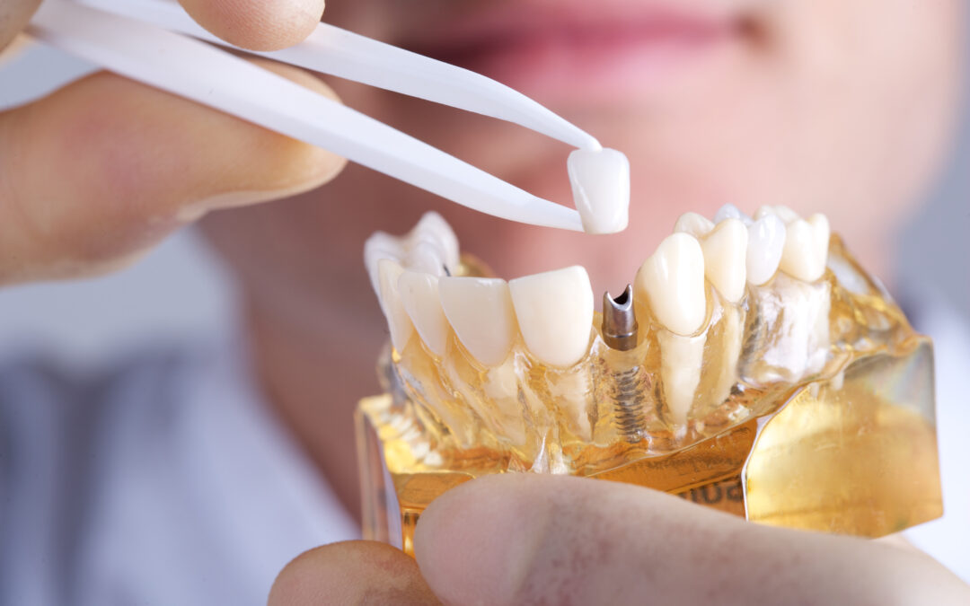 Dental Implants Are Better Than Denture – Eagle Creek Dental