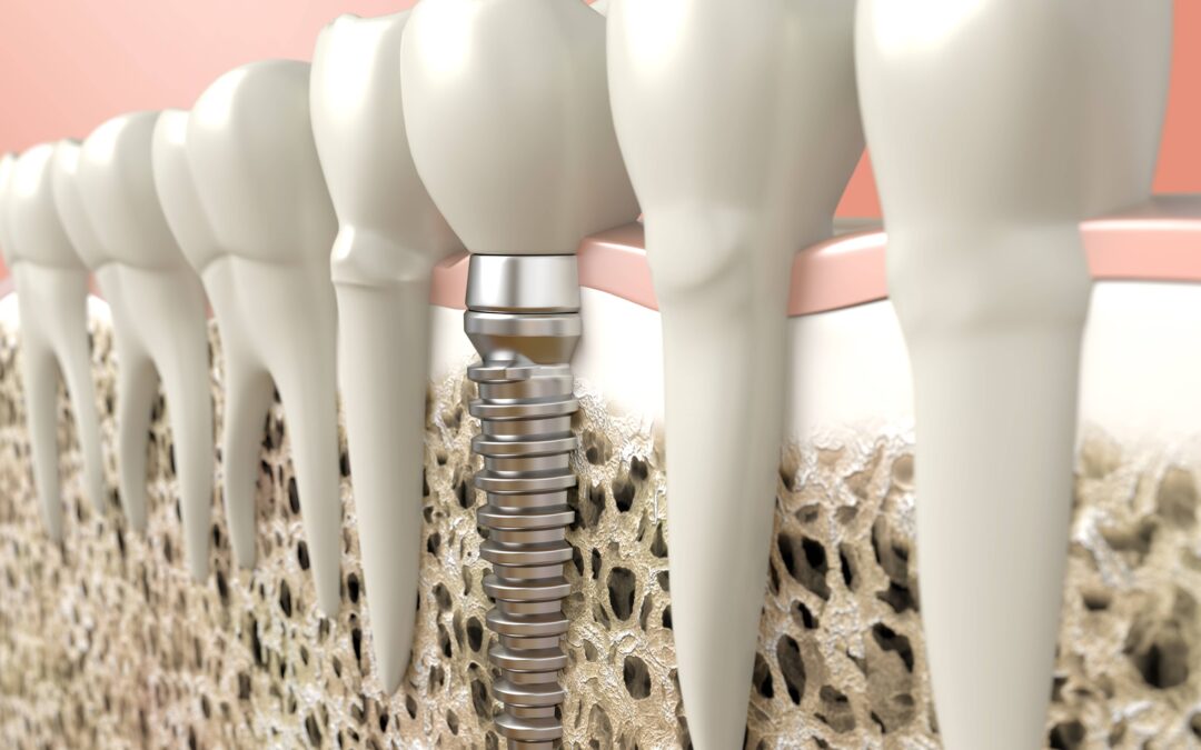 Structure of Dental Implant