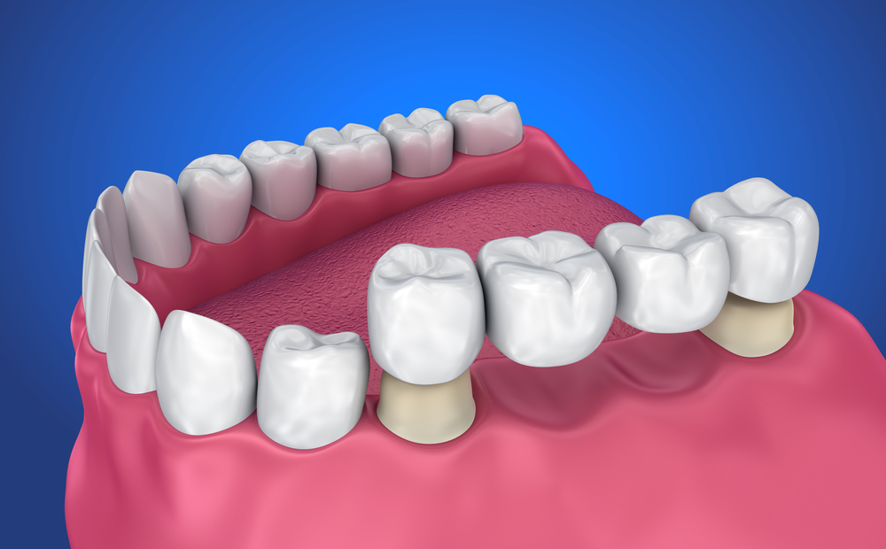 How To Properly Floss With A Dental Bridge